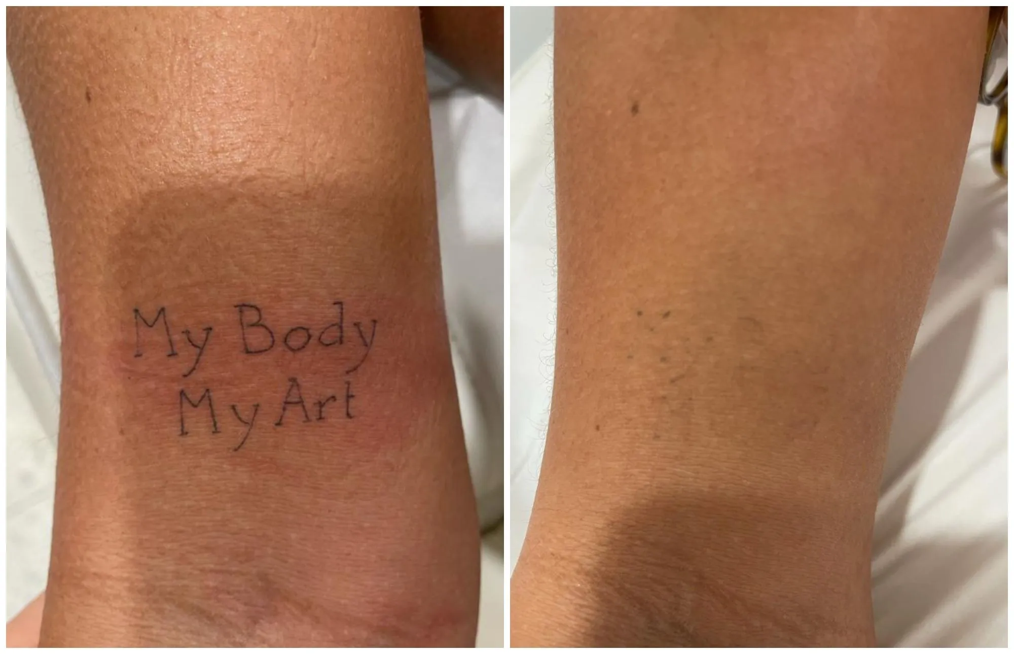 Avant/Après détatouage