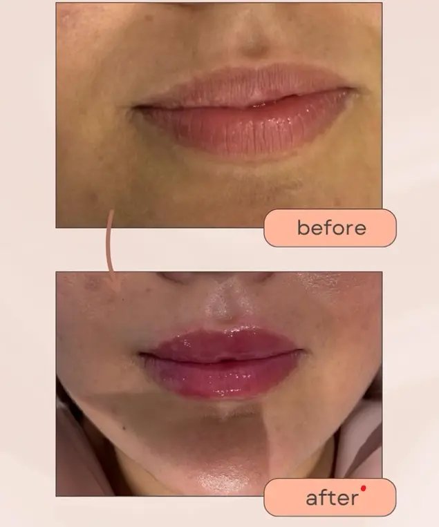 Avant/Après beautification des lèvres