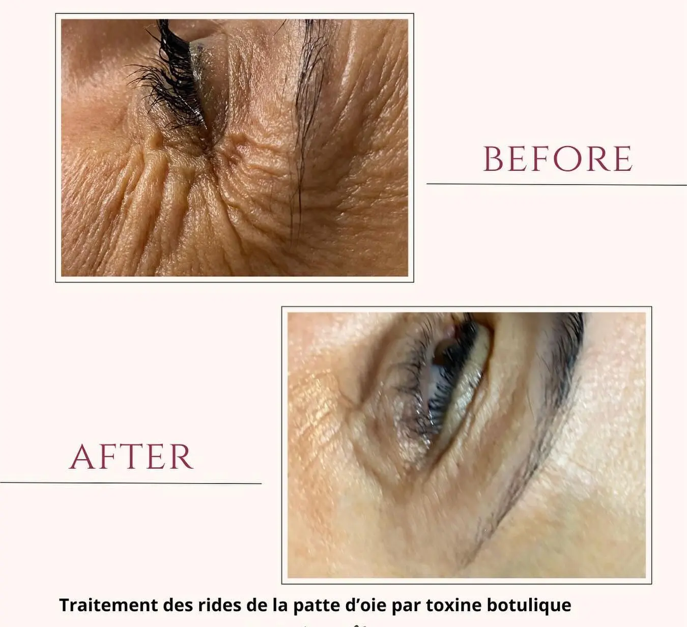 Avant/Après traitement des rides